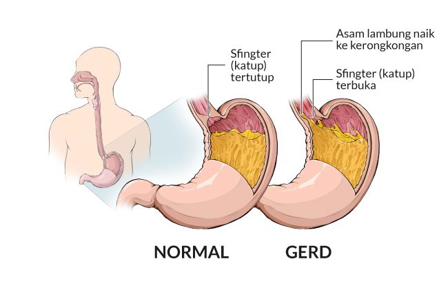 contoh gambar lambung sehat dan mengalami gerd